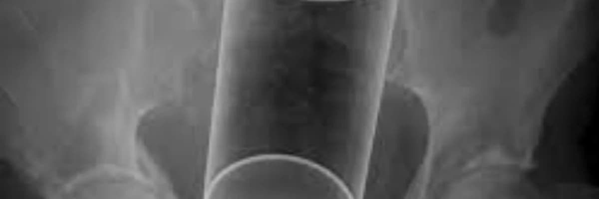 Düz bağırsaqda yad cisim