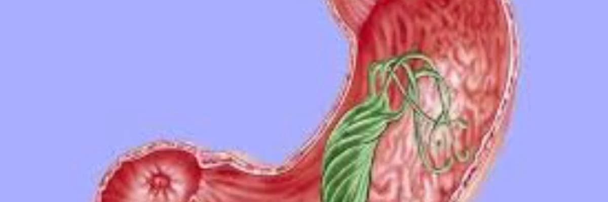 Atrofik Qastrit və İntestinal metaplaziya