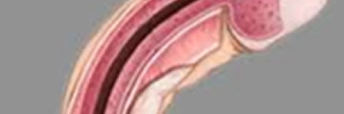 Peyroni xəstəliyi (penisin əyriliyi)