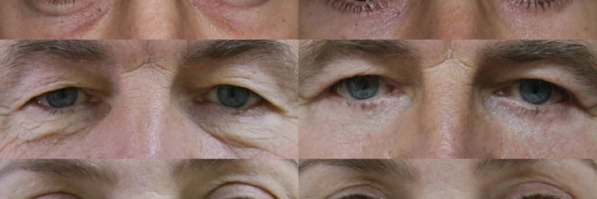 Blefaroplastika