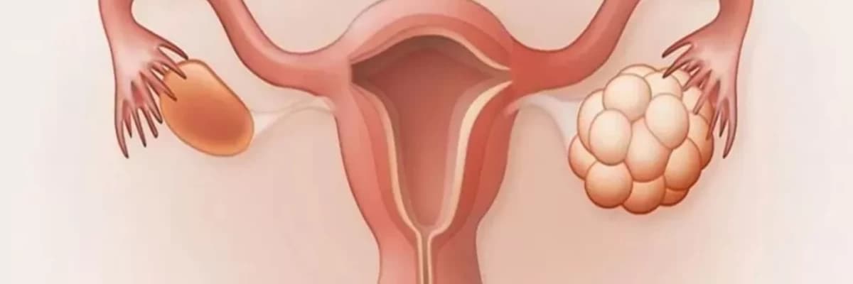 Polikistik yumurtalıq sindromu (PCOS)