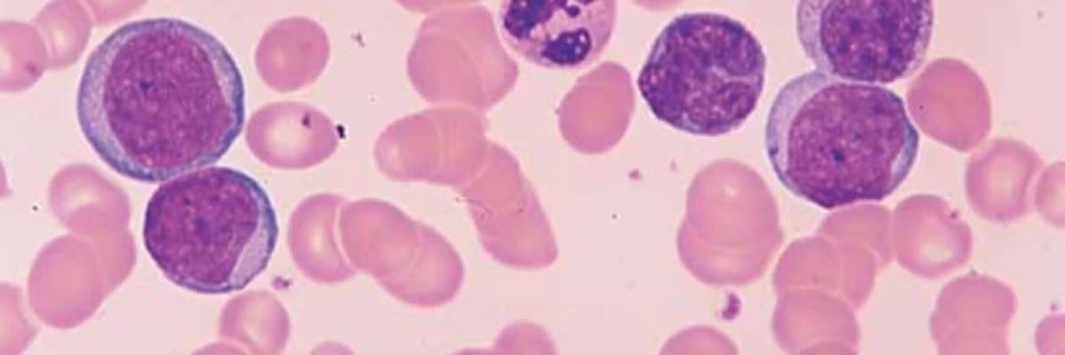 Xroniki Miyeloid Leykemiya (XML)