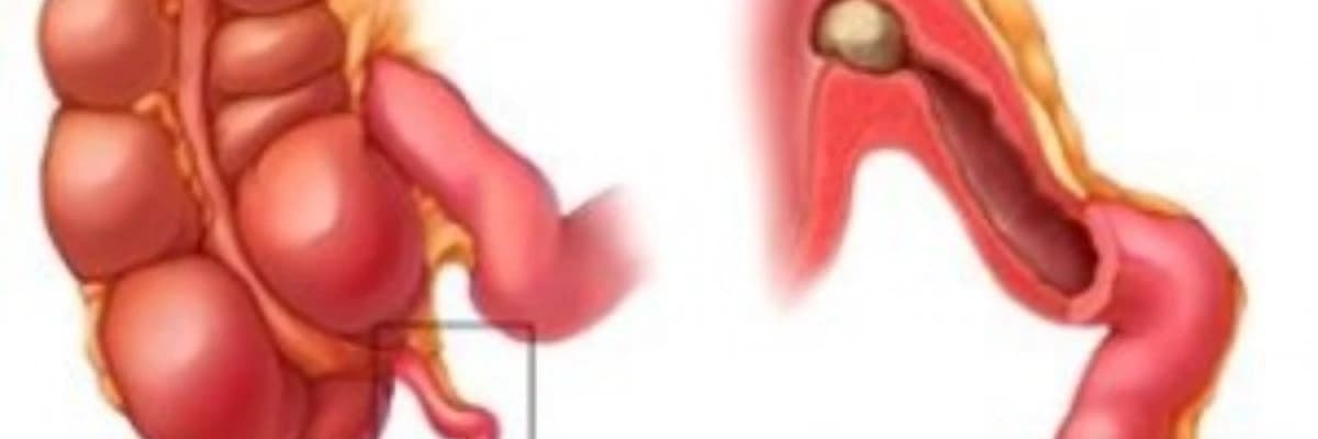 Uşaqlarda kəskin appendisit (APENSİT)