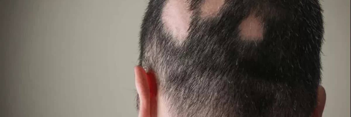 Alopesiyalar (Saç tökülməsi)