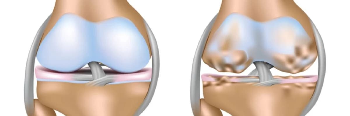 Osteoartrit və omba protezləri