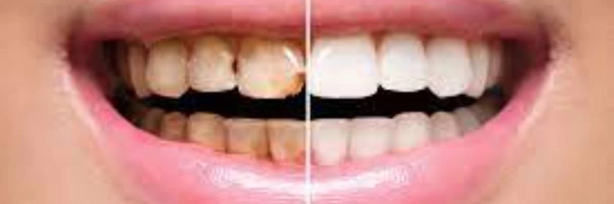 Estetik Stomatologiyanın Prosedurları və Onların Gülüşə Təsiri