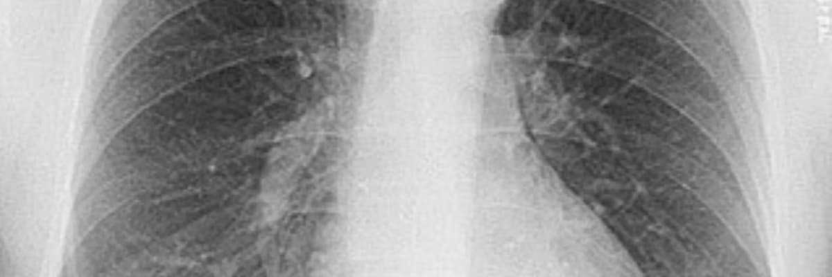 Birincil və ikincil pnevmotoraks - qazların, plevrə havanın yığılması.