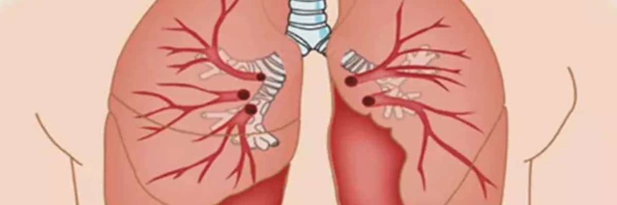 Pulmonar tromboendarterektomiya haqqında