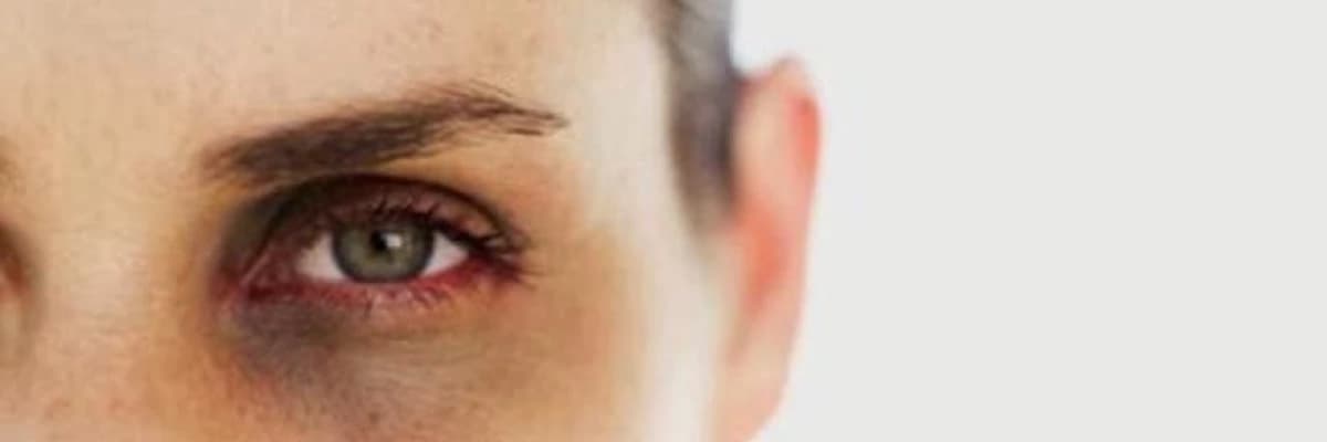 Göz altı kölgələrin yaranma səbəbləri nələrdir?