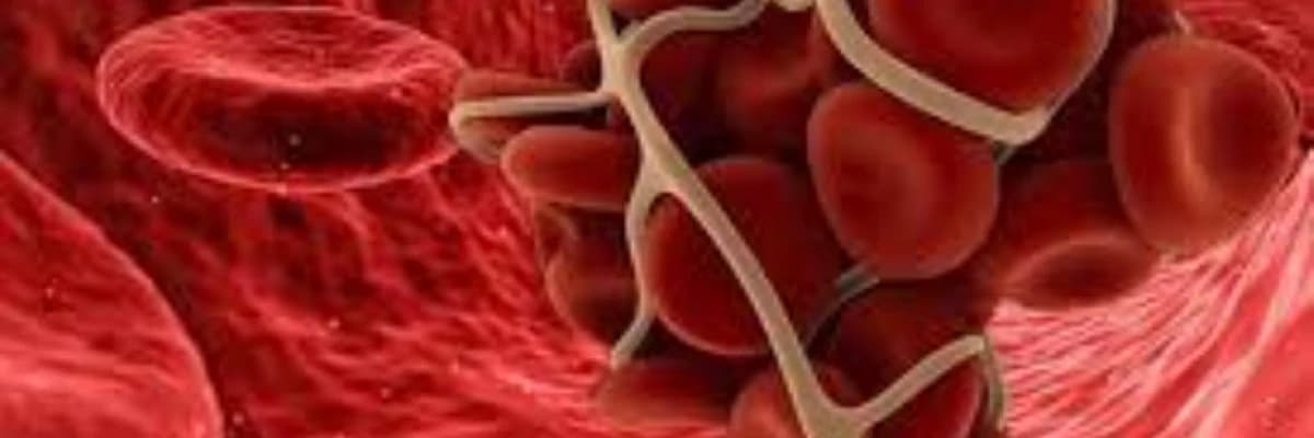 Arterial trombozu