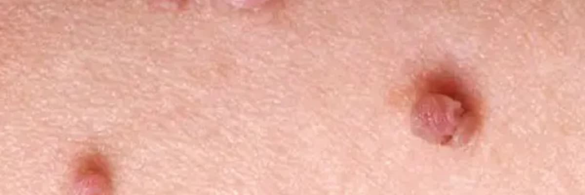 Genital Siğil (hpv) nədir?