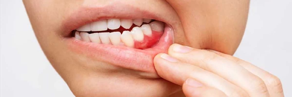 Diş əti resesiyası nədir və necə müalicə olunur?