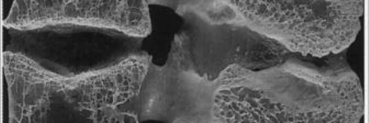 osteoporoz