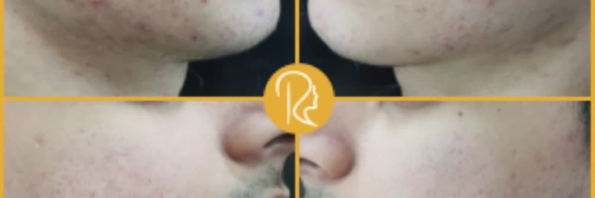 Dermatologiyada Müdaxilədən Əvvəl və Sonra: Hazırlıq və Bərpa Prosedurları