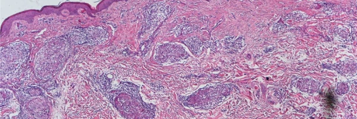 Sarkoidoz - spesifik qranulomaların əmələ gəlməsi ilə ağciyər toxumasının iltihabı