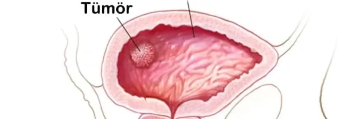 Sidik Kisəsi, Böyrək və Adrenal Vəzi Xərçəngləri: Ümumi Baxış