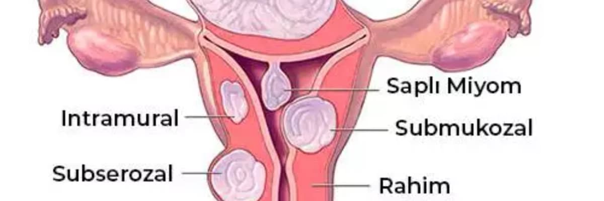 Mioma nədir və necə əmələ gəlir?
