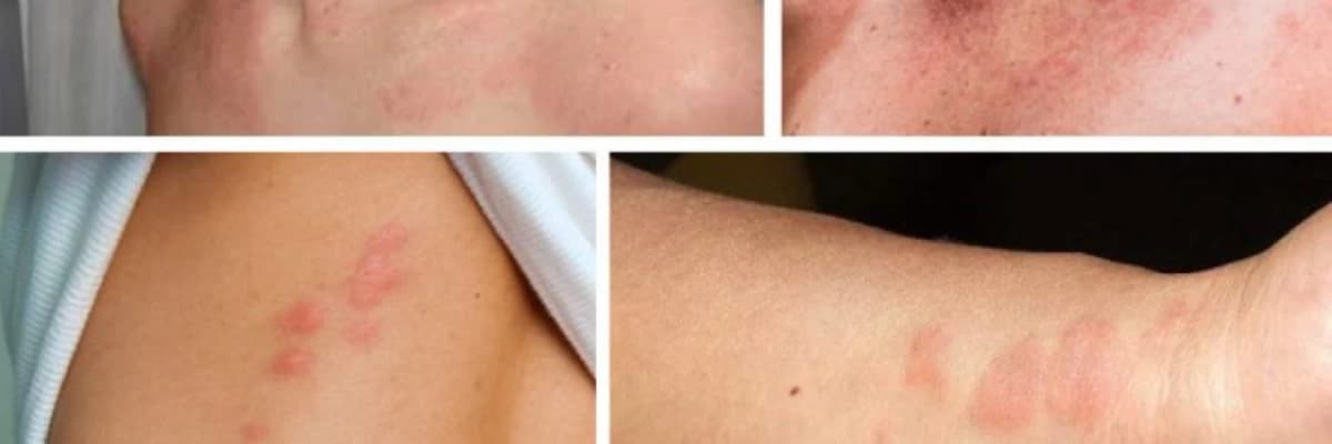 Tatuirovkadan Sonra Meydana Gələn Allergik və Qeyri-Allergik Reaksiyalar:Simptomlar və Müalicə Yolları