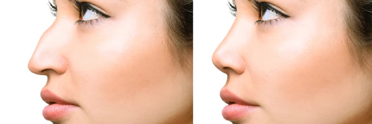 Burun Estetikası (Rinoplastika)