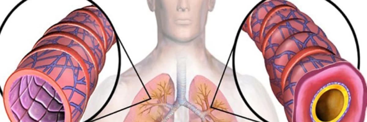 Astma xəstəliyinin müalicəsi