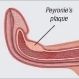 Cinsi orqanın plastik indurasiyası (Peyroni xəstəliyi)