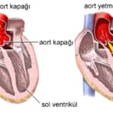 Aorta Çatışmazlığı: Qapaq Ürək Xəstəliyinin Mühüm Forması