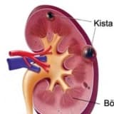 Böyrək kistaları nədir? Müalicə üsulları