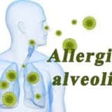 Allergik alveolit