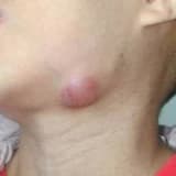 Baş və boyun şişlərinin və onların qüsurlarının təmiri