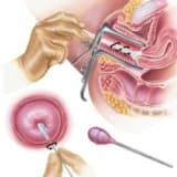 Sitoloji yaxmada aşkar edilmiş dəyişikliklərin (Pap test)