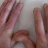 Dermatomiozit/polimiozit
