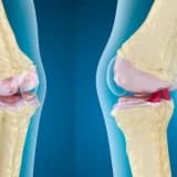 Osteoartrit nədir və necə təsir edir?