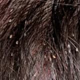 Baş biti: səbəbləri, simptomları və müalicə üsulları