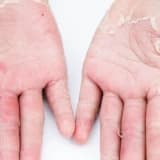 Kontakt Dermatit