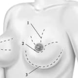 Döş vəzilərinin biopsiyası və patologiyası