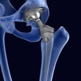 Omba Protezi Cərrahiyyəsi