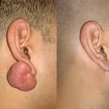 Qulaq seyvanından xoşxasssəli törəmələrin götürülməsi (keloid, lipoma və s)
