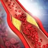 Yüksək Xolesterol