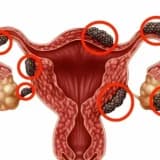 Endometriozun əlamətləri hansılardır?