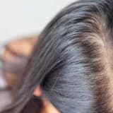 Telogen Effluvium