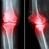 Kirəclənmə / osteoartrit