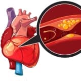 Koronar Arteriya Xəstəliyi