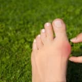 Hallux valgus xəstəliyi