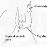 Oğlanlarda testislərin burulması: simptomlar, səbəblər və müalicə