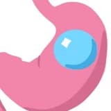 Mədə balonunun yerləşdirilməsi