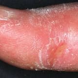 Sistem skleroz (skleroderma)
