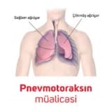 Birincil və ikincil pnevmotoraks - qazların, plevrə havanın yığılması