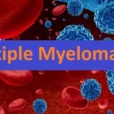 Multiple myeloma