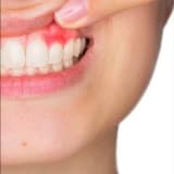 Diş əti iltihabının (gingivitis) müalicəsi