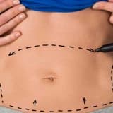 Abdominoplastika: Qarın Estetiği və Funksional Korreksiya Cərrahiyyəsi